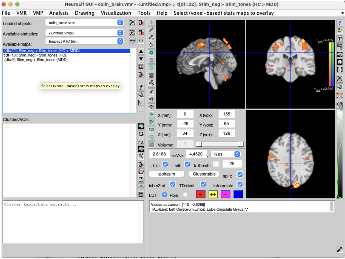 Voxel-based contrast map showing differential activation between healthy controls and MDD group