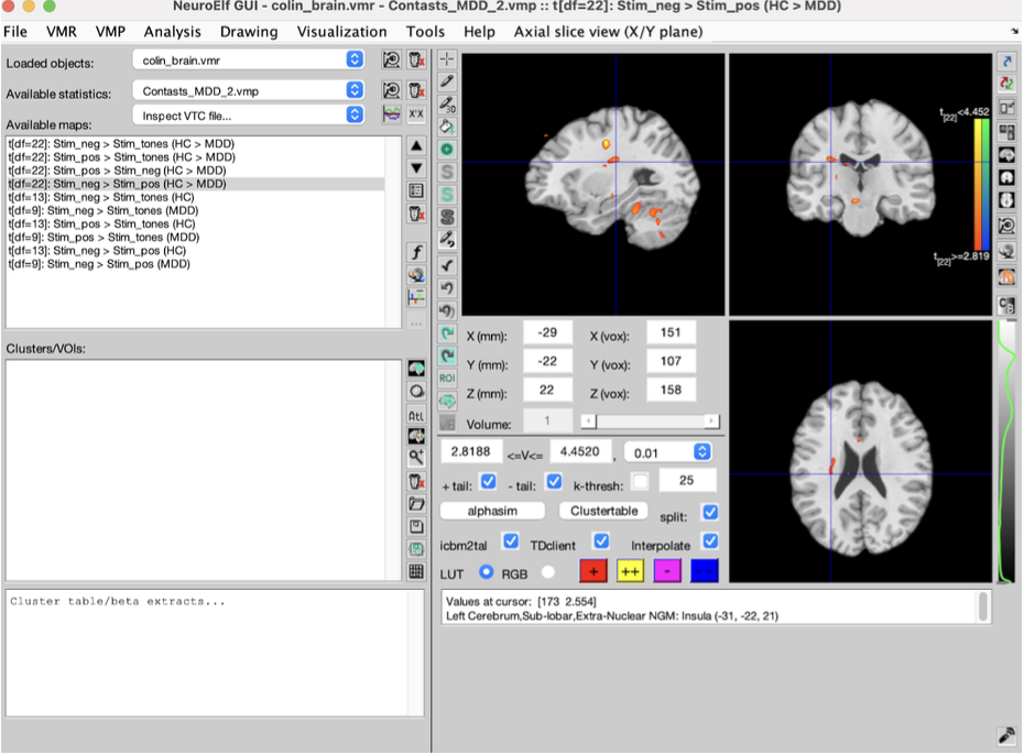 Axial slice showing insula activation in negative vs positive emotional contrast
