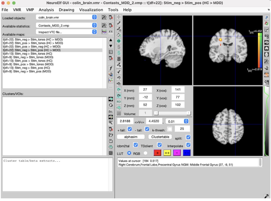 Middle frontal gyrus activation in negative vs positive emotional processing