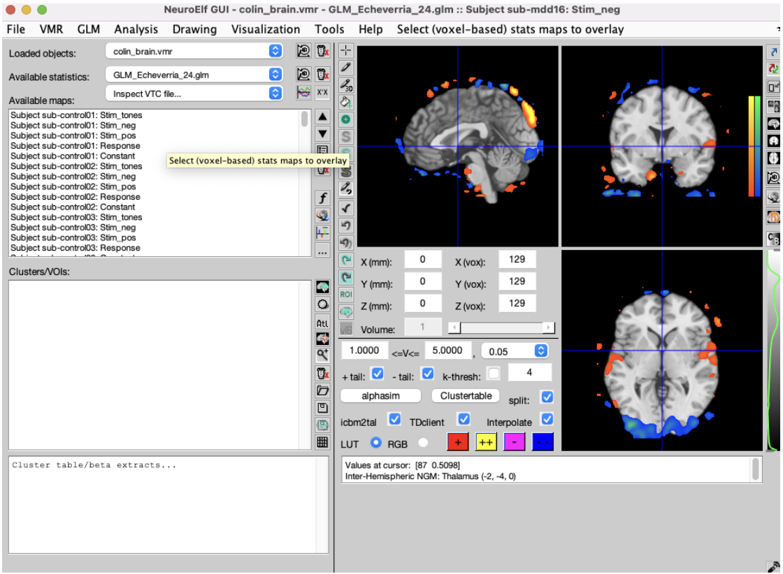 Subject sub-mdd16 brain activation under negative emotional stimuli